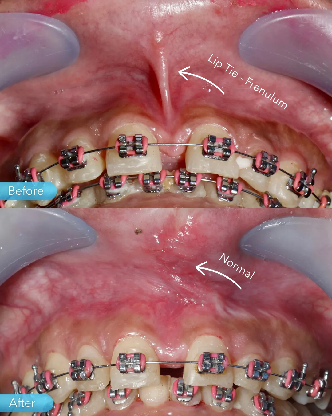 Gum surgery result